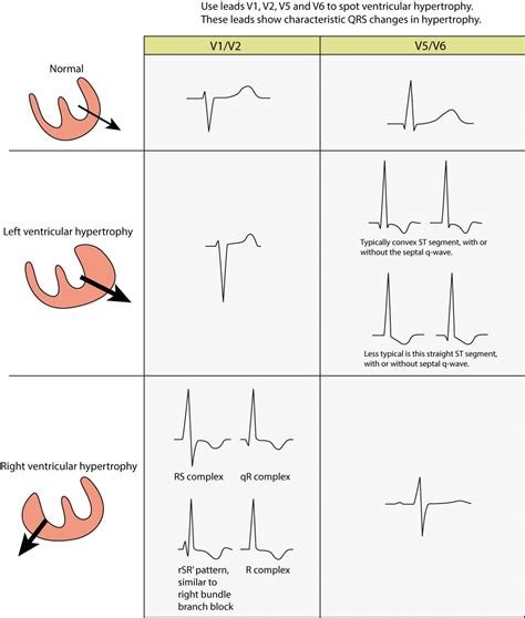 lv q|Left ventricular hypertrophy .